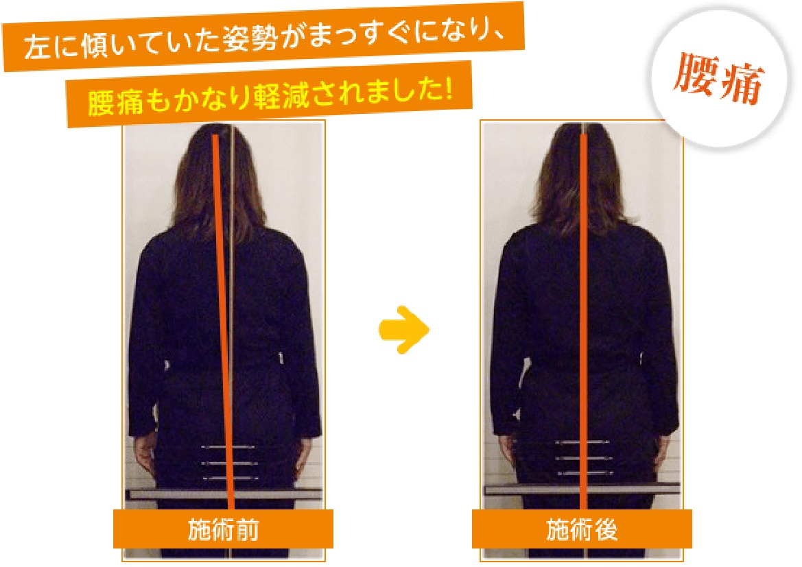 ひと目で効果が分かるビフォアー・アフター(腰痛)01