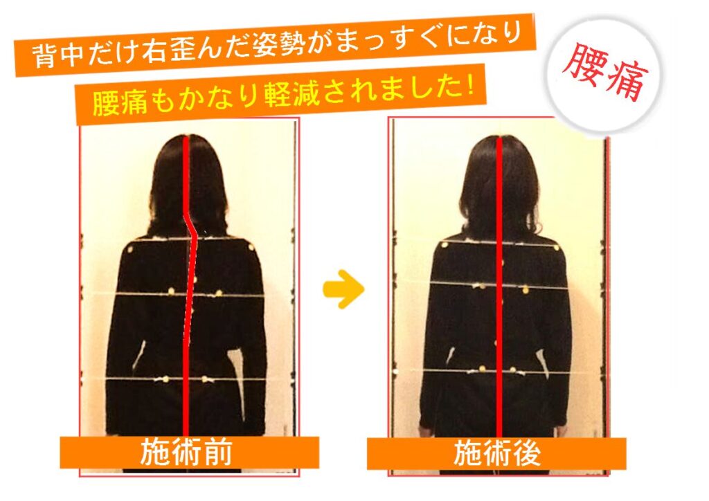 ひと目で効果が分かるビフォアー・アフター(腰痛)02